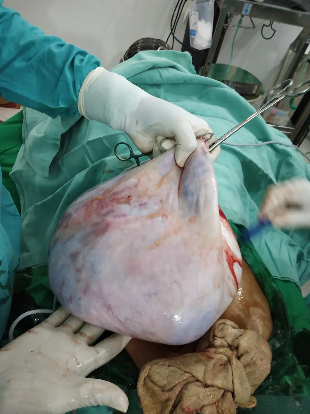 Clinical surgical specimen photographed in an operating theatre